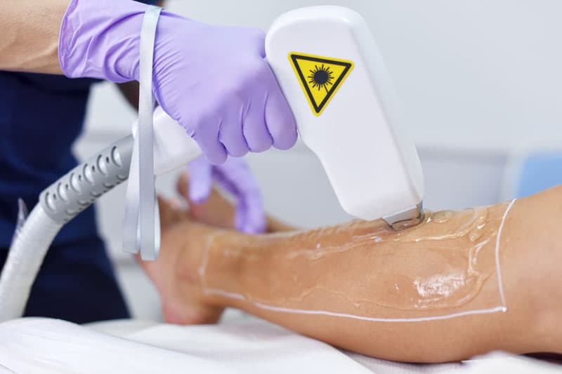 Fotodepilación o luz pulsada