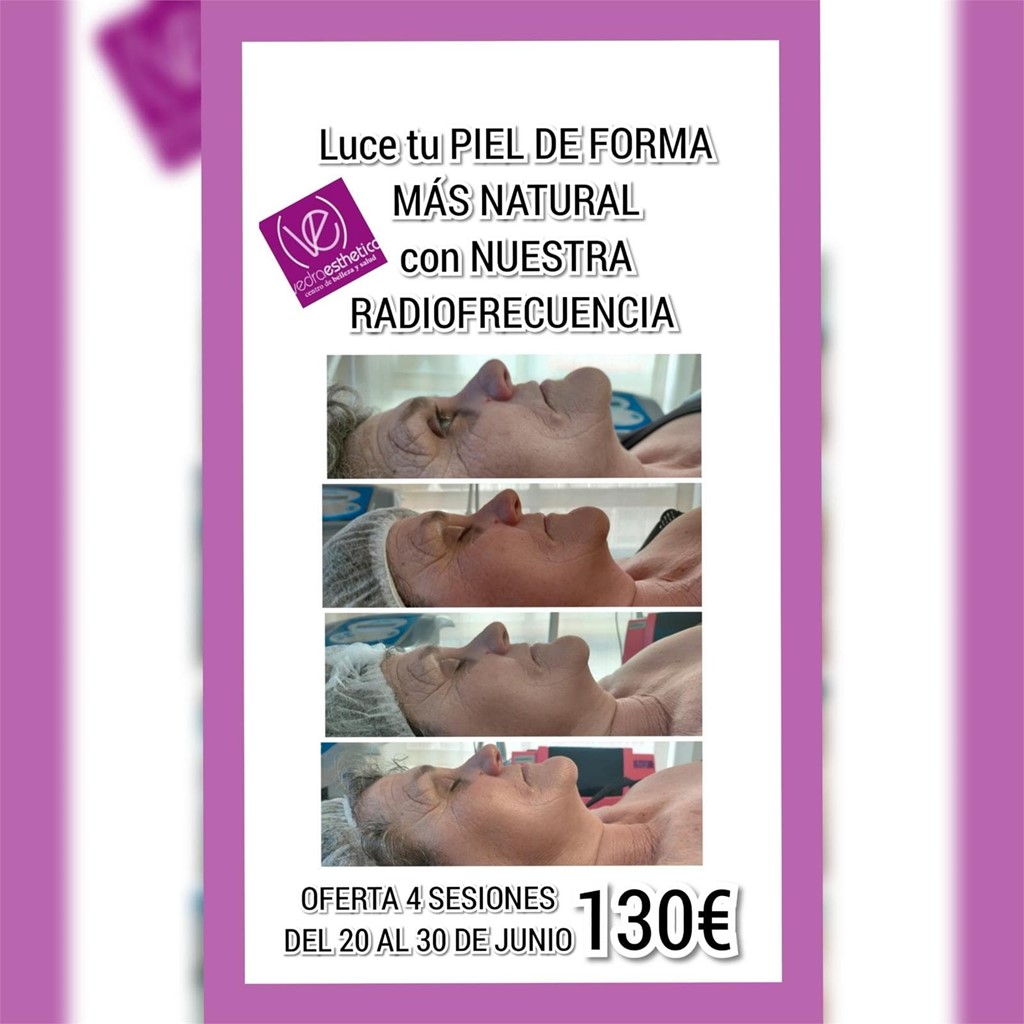 OFERTA... RADIOFRECUENCIA FACIAL 