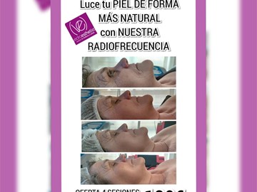 OFERTA... RADIOFRECUENCIA FACIAL 