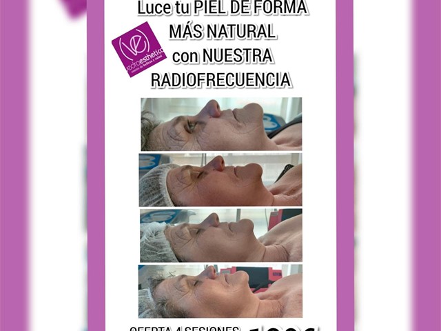 OFERTA... RADIOFRECUENCIA FACIAL 